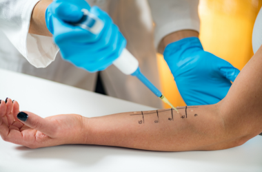 Skin Prick Allergy Test