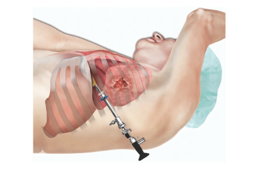 Thoracoscopy