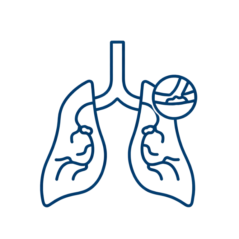 Sarcoidosis